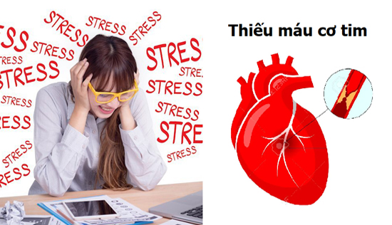 Càng căng thẳng, stress, bạn càng dễ gặp các biến chứng thiếu máu cơ tim hơn